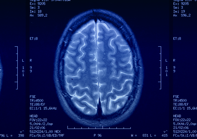 Biomultidata (omic, environmental, demographic, clinical and neuroimaging) analysis per the original hypothesis-free approach for disease risk assessmentand outcome prediction